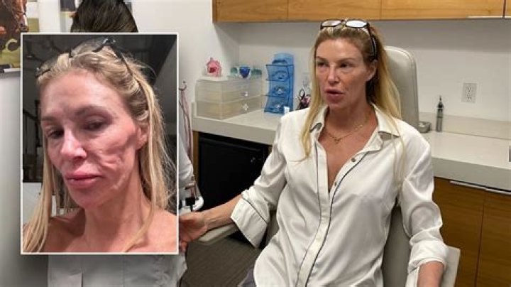 Brandi Glanville explained why her face has changed since RHOBH season 2 Fri 24 June 2022 12:19