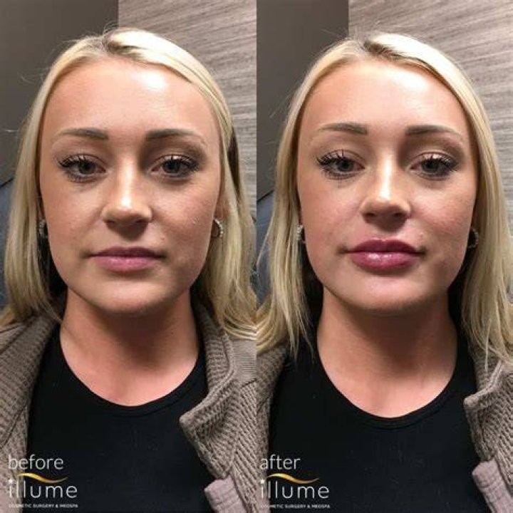 Did Gwen Stefani Get Lips Surgery? Before And After Photos