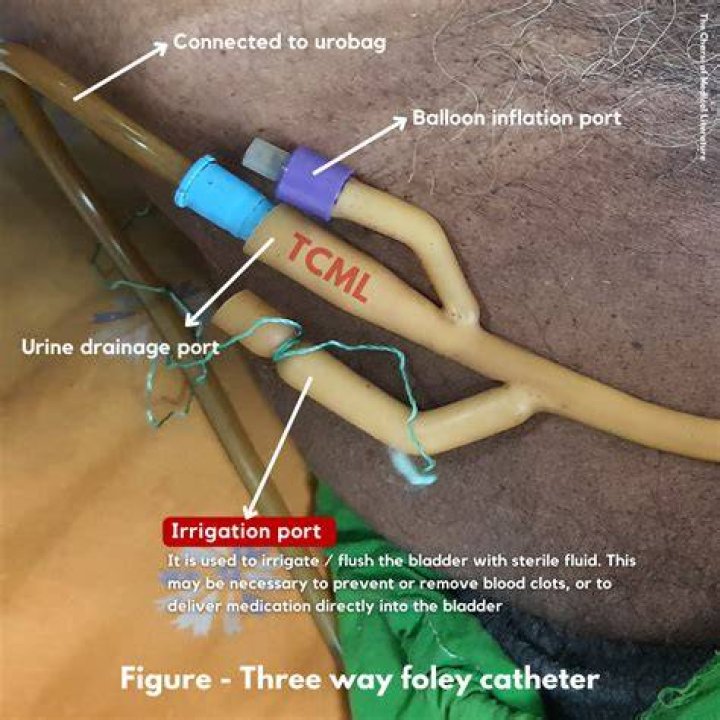 How do you irrigate a 3 way Foley catheter?