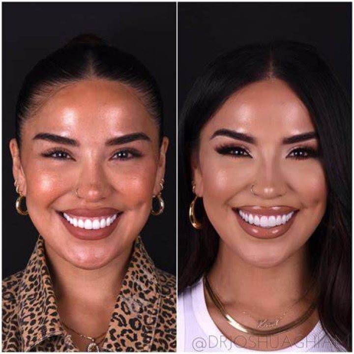 Iluvsarahii's BBL Transformation: Before and After