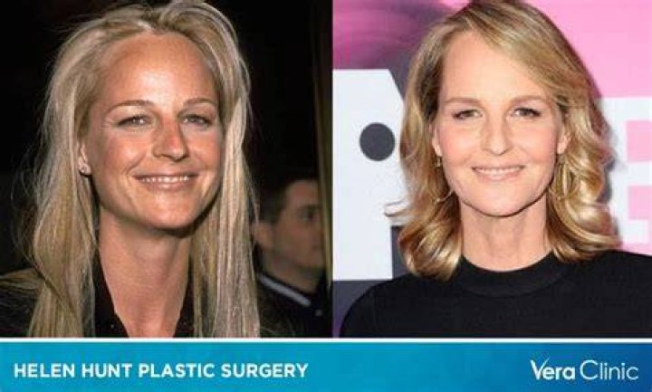 Is Helen Hunt Sick? What Happened To Helen Hunt Face? Has Helen Hunt Had Plastic Surgery? Why Does H
