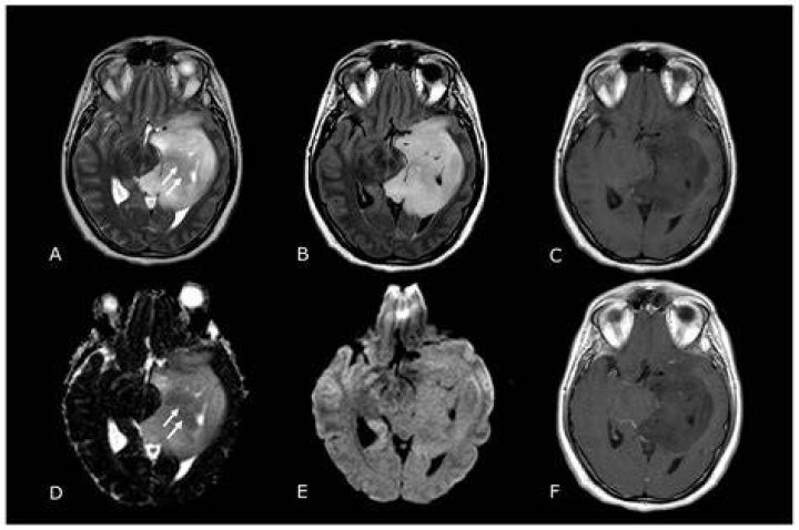 Resilience Amidst a Brain Tumor Diagnosis