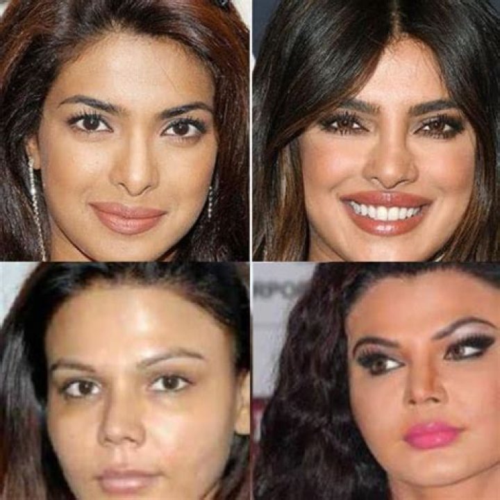 Sherlyn Chopra's Plastic Surgery Journey: Before and After