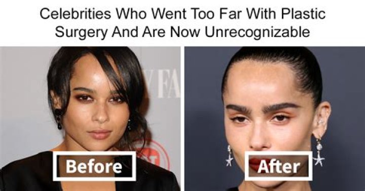 Singer Kehlani Reveals The After-effect Of Plastic Surgery