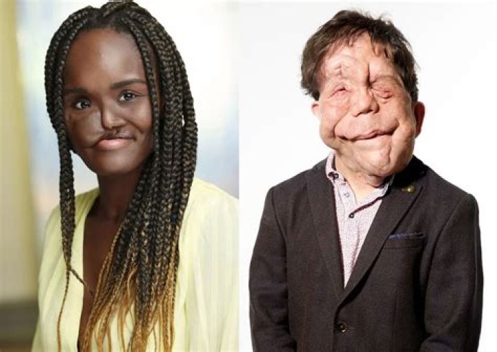 Understanding Adam Pearson's Girlfriend: A Deep Dive into His Personal Life