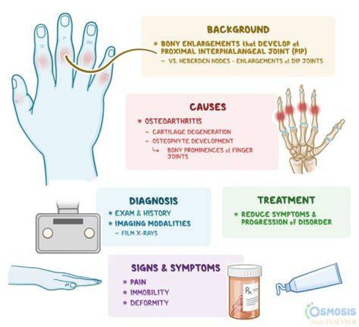 Understanding Matthew Perry Fingers: Causes, Symptoms, and Treatment